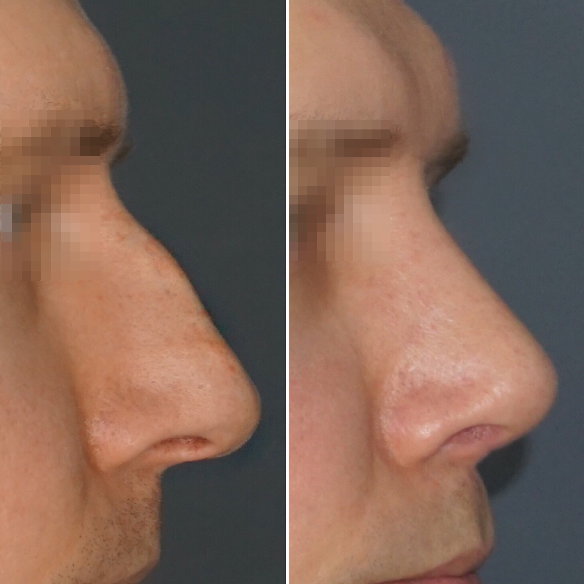 Ринопластика спинки носа